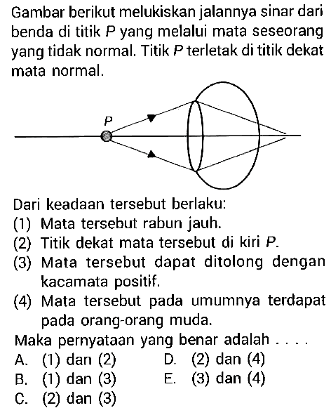 Gambar berikut melukiskan jalannya sinar dari benda di titik P yang melalui mata seseorang yang tidak normal. Titik P terletak di titik dekat mata normal. Dari keadaan tersebut berlaku: (1) Mata tersebut rabun jauh. (2) Titik dekat mata tersebut di kiri P. (3) Mata tersebut dapat ditolong dengan kacamata positif. (4) Mata tersebut pada umumnya terdapat pada orang-orang muda. Maka pernyataan yang benar adalah .... A. (1) dan (2) D. (2) dan (4) B. (1) dan (3) E. (3) dan (4) C. (2) dan (3)