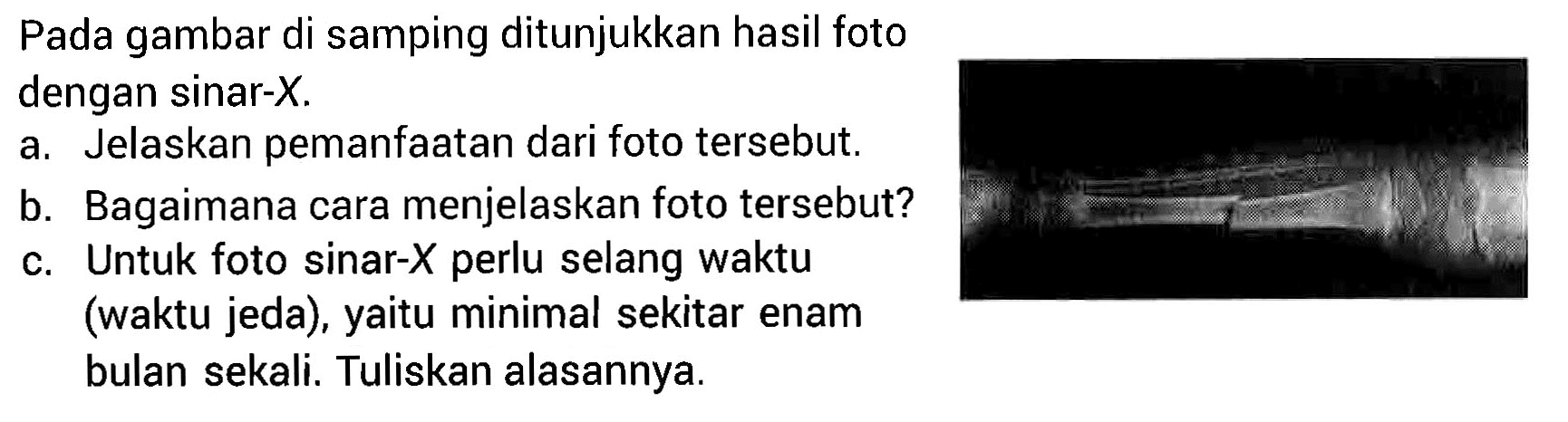 Pada gambar di samping ditunjukkan hasil foto dengan sinar-  X .
"(Hasil X-Ray)"
a. Jelaskan pemanfaatan dari foto tersebut.
b. Bagaimana cara menjelaskan foto tersebut?
c. Untuk foto sinar-  X  perlu selang waktu (waktu jeda), yaitu minimal sekitar enam bulan sekali. Tuliskan alasannya.