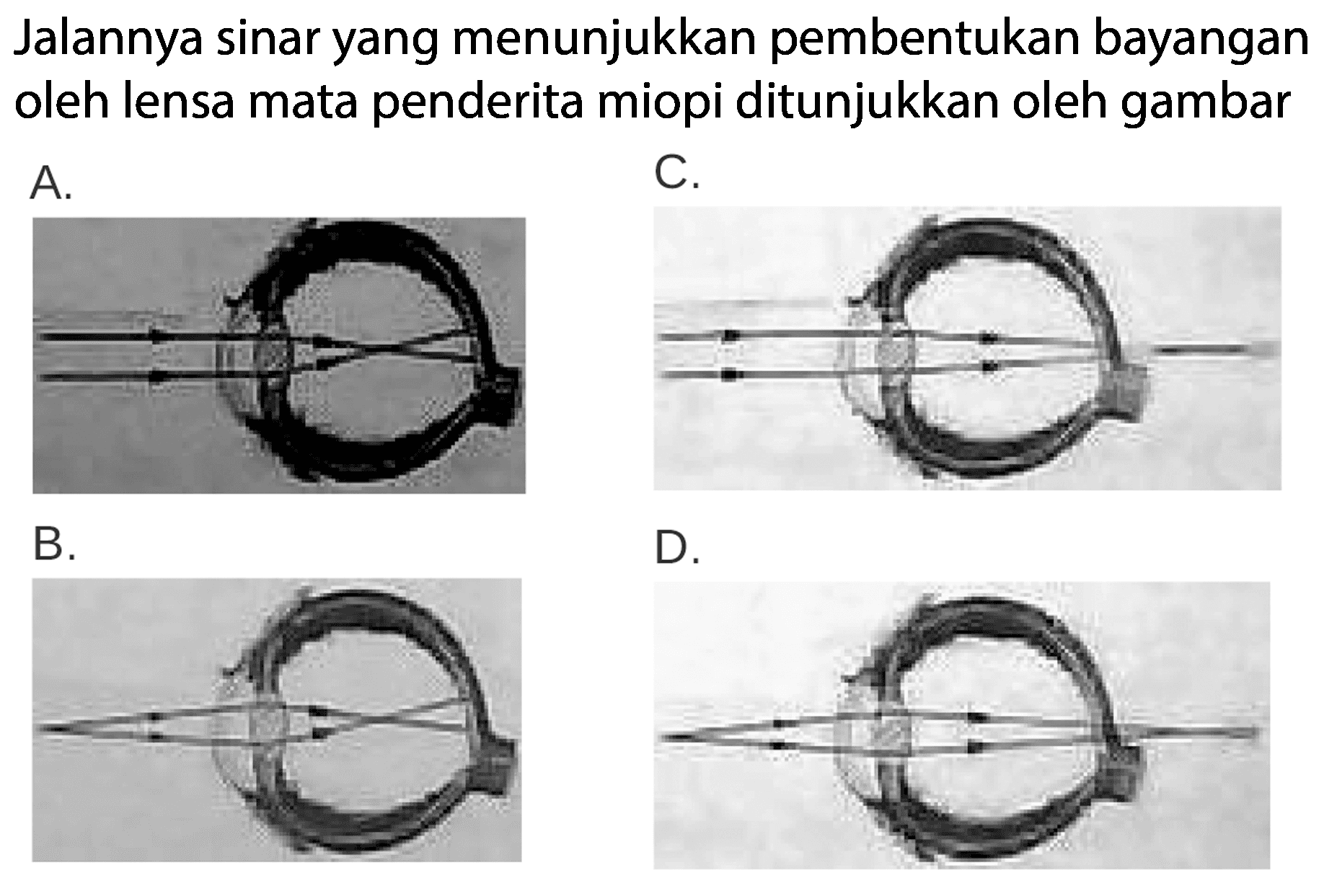 Jalannya sinar yang menunjukkan pembentukan bayangan oleh lensa mata penderita miopi ditunjukkan oleh gambar
A.
B.
D.